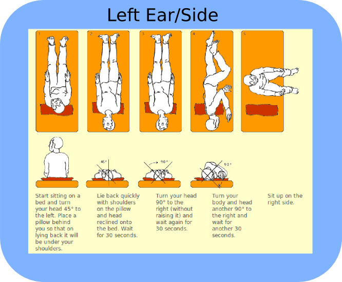 Left Sided BPPV Treatment