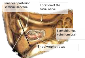 Endolymphatic Sac Surgery