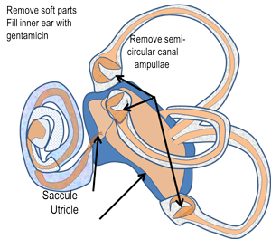 Surgical Labyrinthectomy