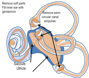 Surgical Labyrinthectomy Surgical Labyrinthectomy