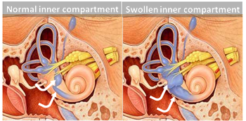 Ménière's Inner Swelling