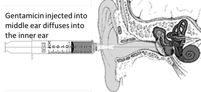 Chemical Labyrinthine Treatment: Gentamicin or Dexamethasone