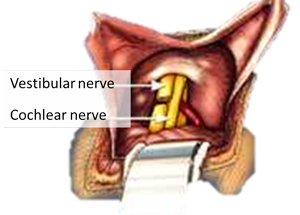 Vestibular Nerve Section