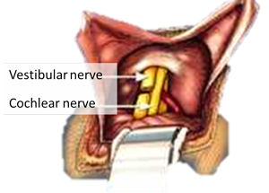 Vestibular Nerve Section Vestibular Nerve Section