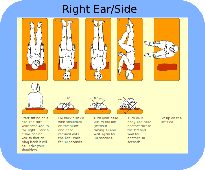 ear crystals vertigo epley maneuver