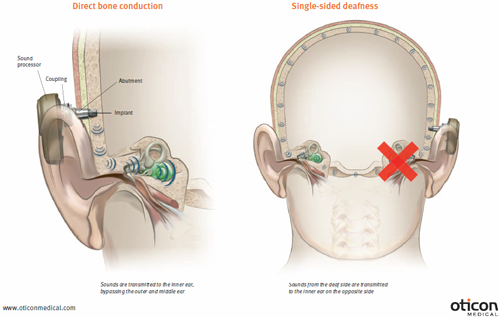Schematic of a Bone Anchored Hearing Aid