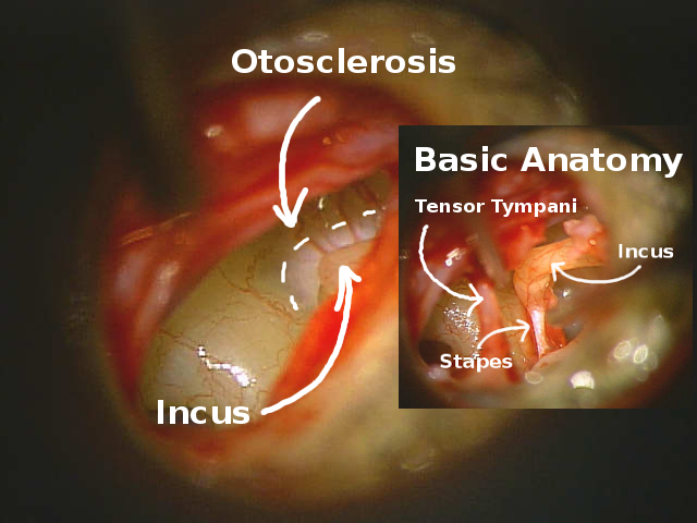 Stapedotomy Animation to Treat Otosclerosis (Curable Type of