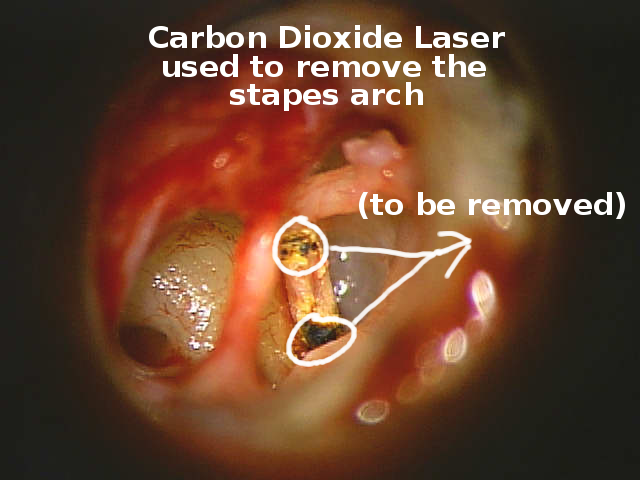 Otosclerosis and stapes surgery — Hearing Institute